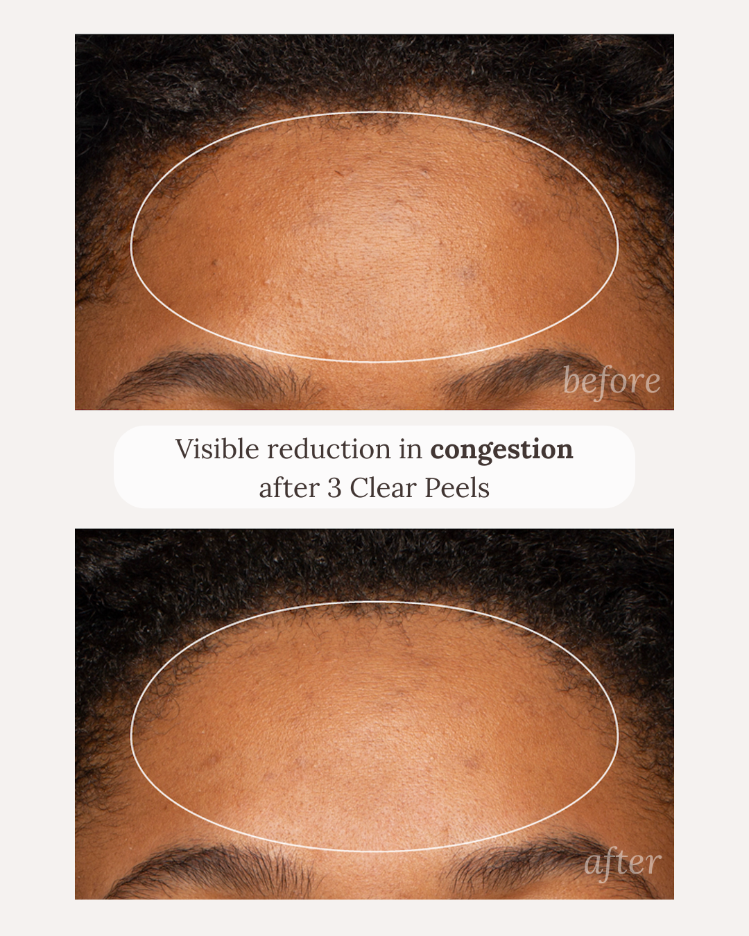 Visible reduction in congestion after 3 clear peels