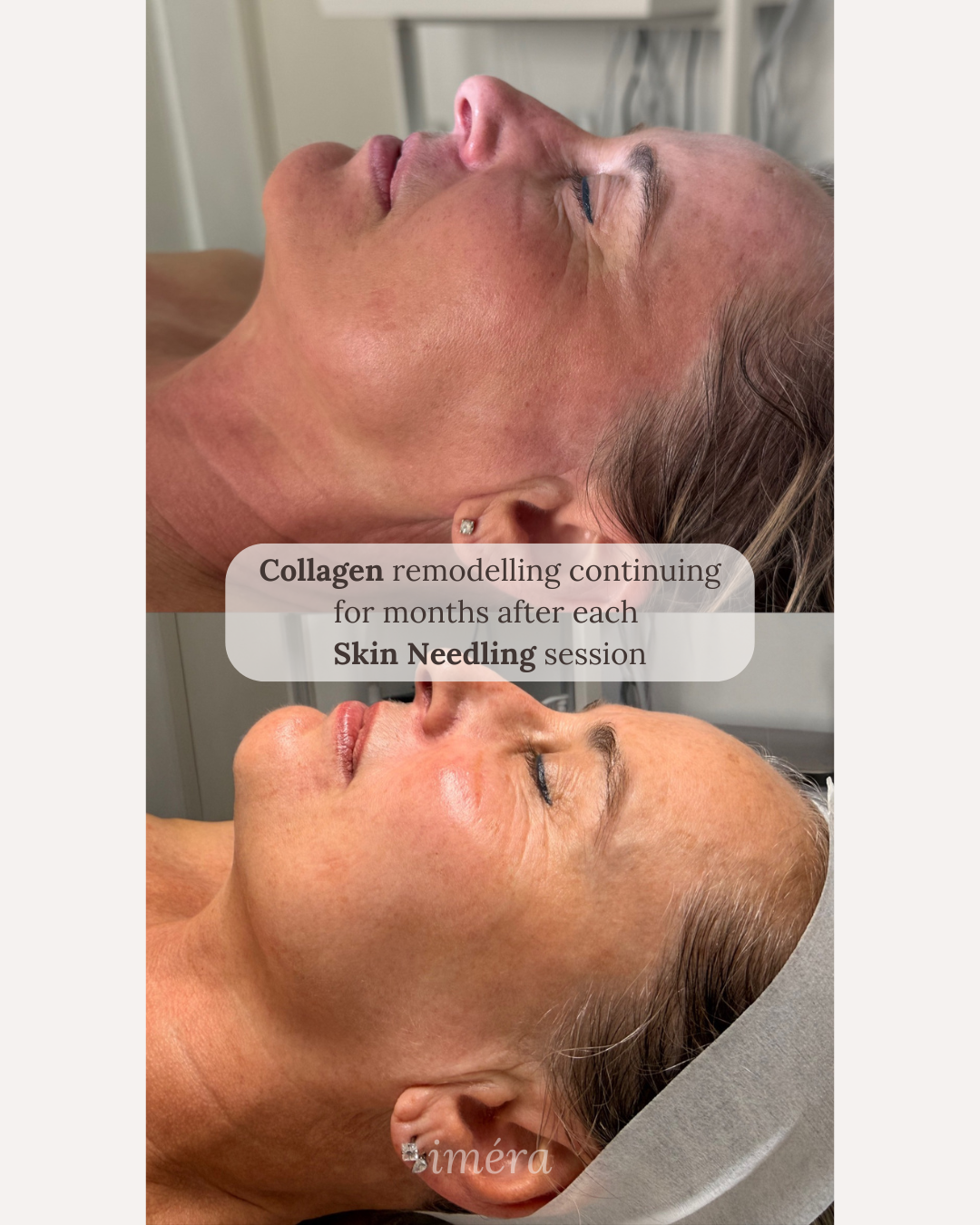 Stronger, healthier barrier after Skin needling program
