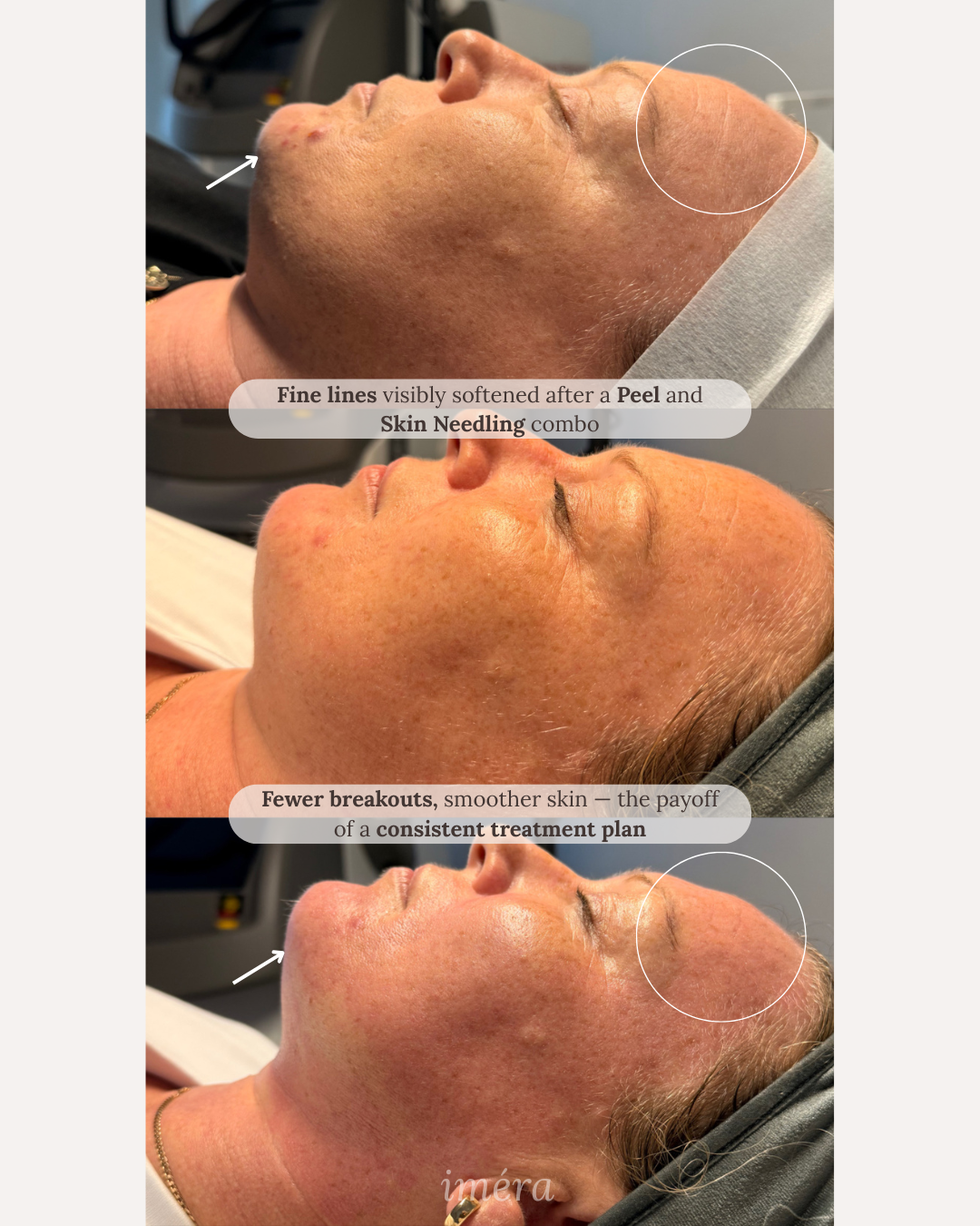 Refined texture and clarity after Peel + skin needling program